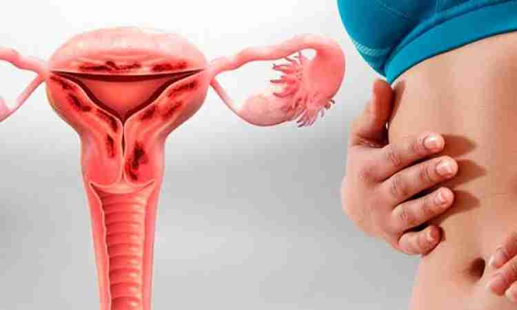 Adenomiose Uterina: compreendendo uma condição desafiadora